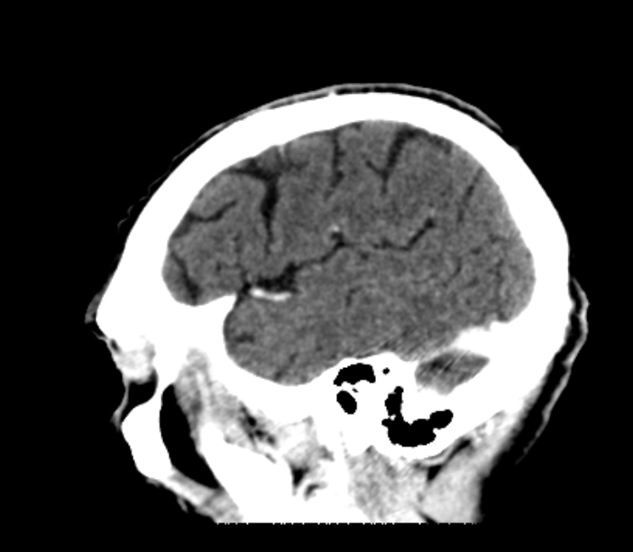 Brain metastases from lung cancer (Radiopaedia 27849-28092 Sagittal C+ delayed 50).jpg