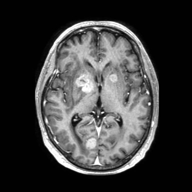 Brain metastases from lung cancer (Radiopaedia 83839-99028 Axial T1 C+ 31).jpg