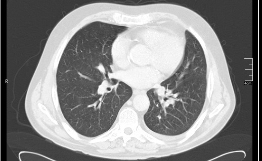 File:Brain metastases from squamocellular lung cancer (Radiopaedia 56515-63219 Axial lung window 38).jpg