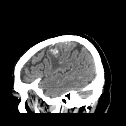 Brain metastasis (Radiopaedia 42617-45760 D 47).jpg