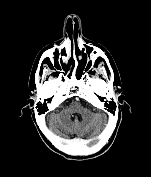 Brain metastasis (large cystic mass) (Radiopaedia 47497-52106 Axial C+ 19).png