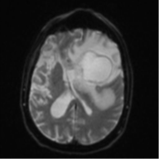 Brain metastasis (lung cancer) (Radiopaedia 48289-53179 Axial DWI 16).png