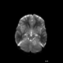 File:Brainstem ganglioglioma (Radiopaedia 10763-11224 Axial DWI 12).jpg