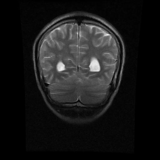 File:Brainstem glioma (Radiopaedia 30923-31624 Coronal T2 4).jpg
