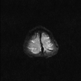 Brainstem glioma (Radiopaedia 67531-76922 Axial DWI 22).jpg