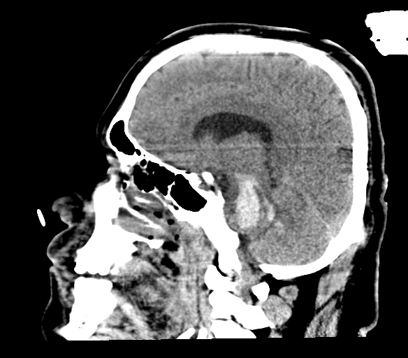 Brainstem hemorrhage (Radiopaedia 81294-94976 C 33).jpg