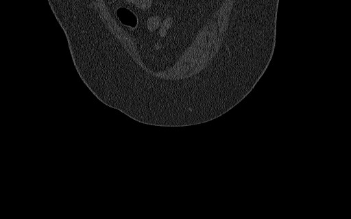 File:Breast carcinoma with pathological hip fracture (Radiopaedia 60314-67993 Coronal bone window 27).jpg