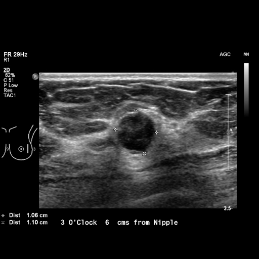 File:Breast metastases from renal cell cancer (Radiopaedia 79220-92226 Left breast US 9).jpeg