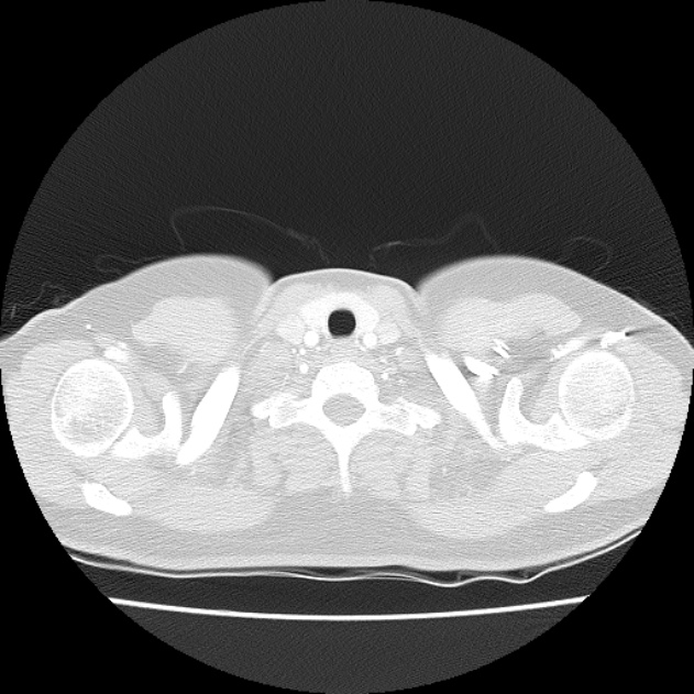 Bronchial atresia (Radiopaedia 22965-22992 Axial lung window 51).jpg