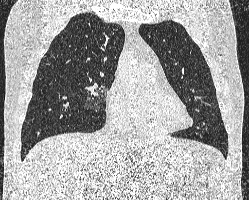 Bronchial atresia (Radiopaedia 58271-65417 Coronal lung window 19).jpg