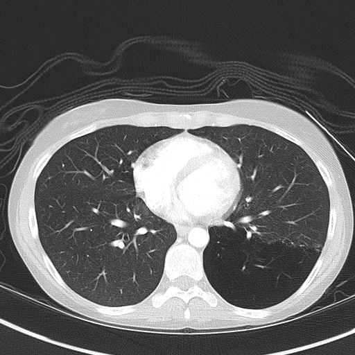 Bronchial atresia (Radiopaedia 73677-84470 Axial lung window 39).jpg