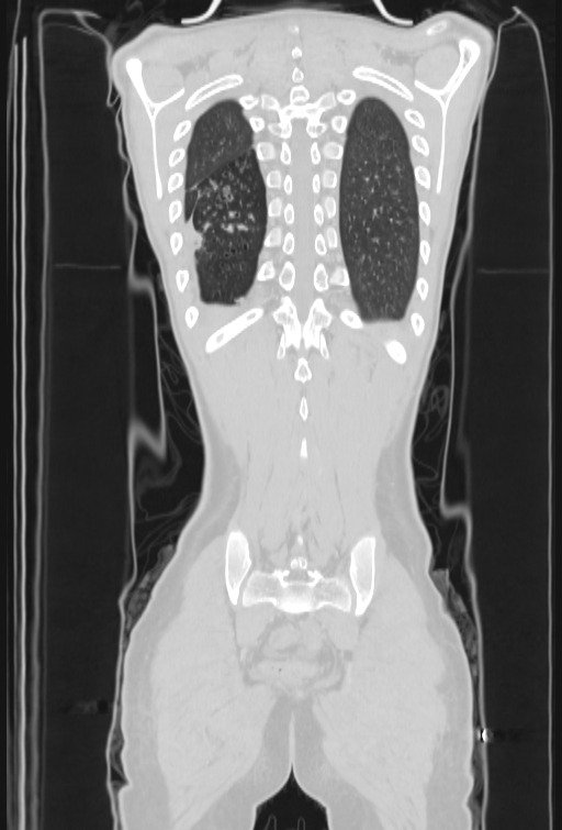 Bronchial carcinoid tumor (Radiopaedia 57187-64090 Coronal lung window 97).jpg