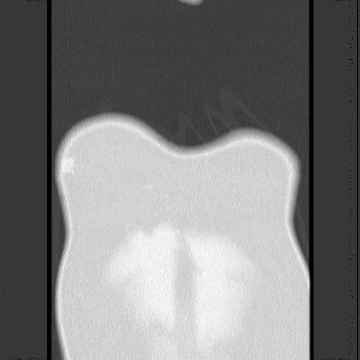 Bronchial carcinoid tumor (Radiopaedia 67377-76764 Coronal lung window 12).jpg