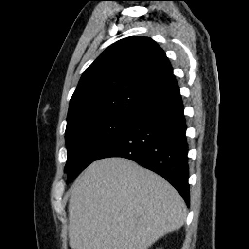 Bronchial carcinoid tumor (Radiopaedia 67377-76764 E 15).jpg