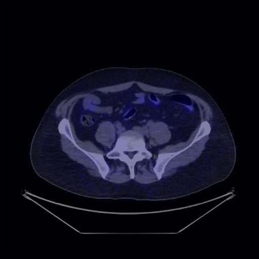 Bronchial carcinoid tumor (Radiopaedia 67377-76765 68Ga-DOTATATE PET-CT 62).jpg