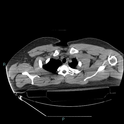 Bronchial carcinoid tumor (Radiopaedia 78272-90870 Axial non-contrast 14).jpg