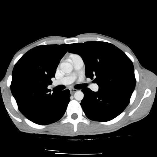 Bronchial carcinoid tumor causing right lower lobe collapse (Radiopaedia 83495-98594 A 22).jpg
