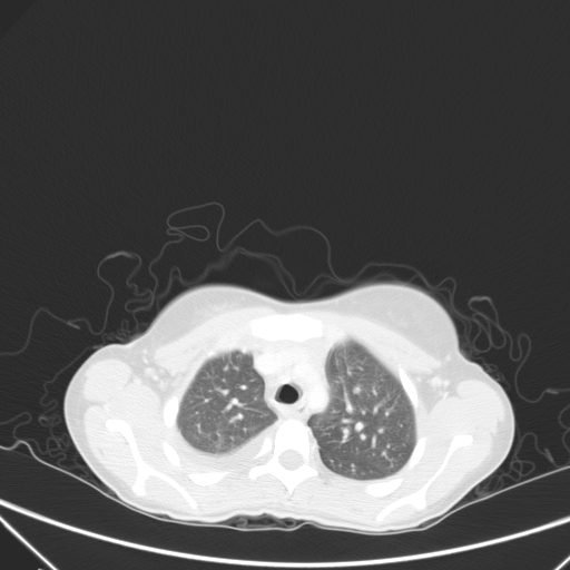 Bronchial mucoepidermoid carcinoma (Radiopaedia 57023-63895 Axial lung window 24).jpg