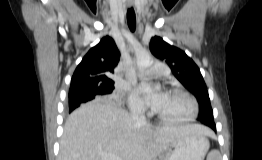Bronchial mucoepidermoid carcinoma (Radiopaedia 57023-63895 Coronal 40).jpg