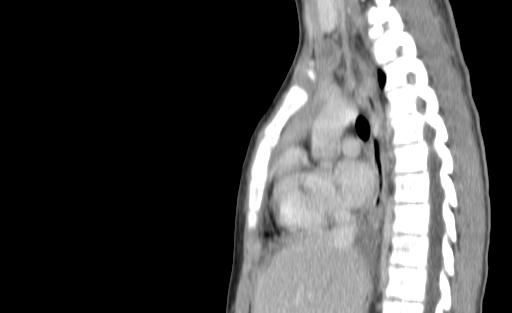 Bronchial mucoepidermoid carcinoma (Radiopaedia 57023-63895 Sagittal 121).jpg