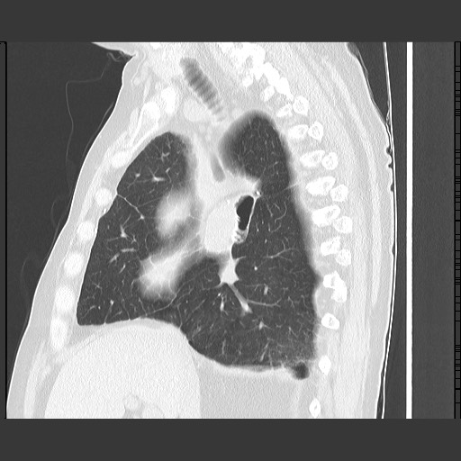 Bronchial stenosis - lung transplant (Radiopaedia 73133-83848 Sagittal lung window 30).jpg