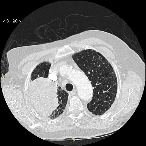 Bronchogenic carcinoma as an incidental finding (Radiopaedia 16453-16130 Axial lung window 90).jpg