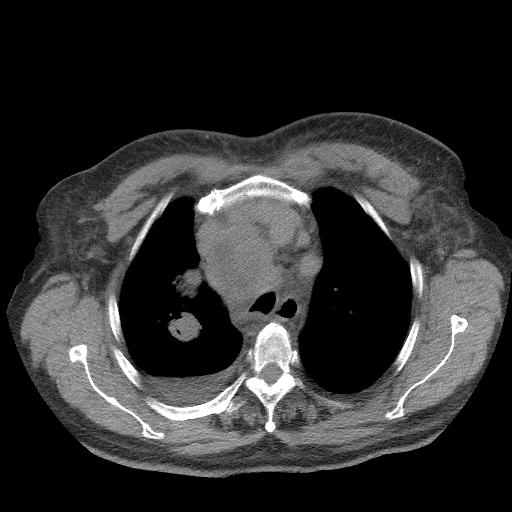 Bronchogenic carcinoma with metastatic lymphadenopathy (Radiopaedia 37671-39569 Axial non-contrast 15).jpg