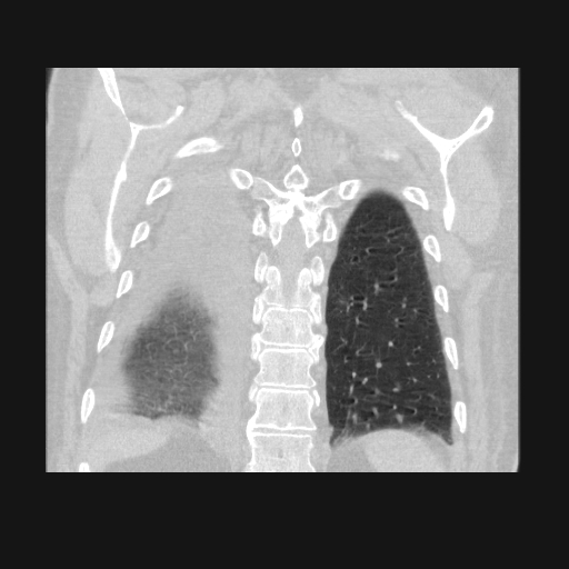 File:Bronchogenic carcinoma with metastatic lymphadenopathy (Radiopaedia 37671-39569 Coronal lung window 39).jpg