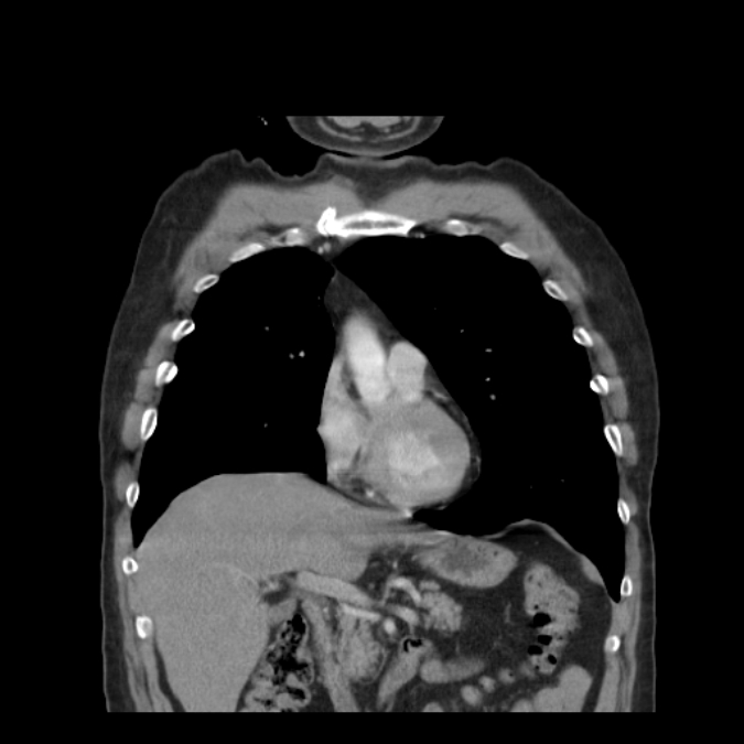 Bronchogenic carcinoma with upper lobe collapse (Radiopaedia 29297-29726 D 22).jpg