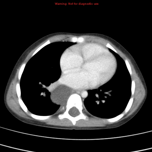 File:Bronchogenic cyst (Radiopaedia 9372-10063 C 14).jpg