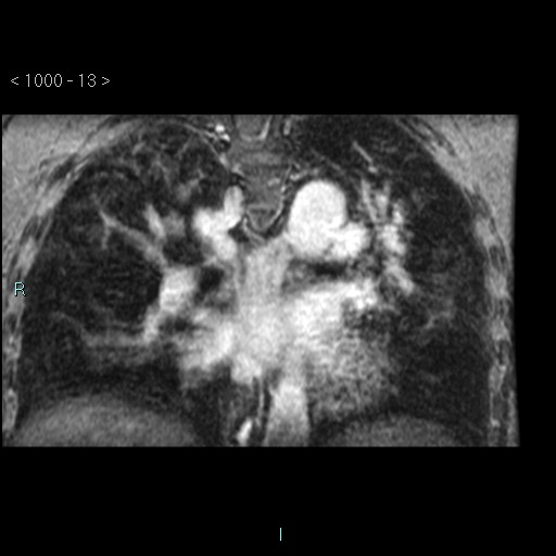 File:Bronchogenic cyst - posterior mediastinal (Radiopaedia 43885-47365 Coronal T1 C+ 12).jpg