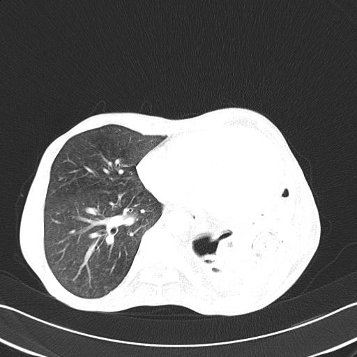 Bronchopleural fistula secondary to tuberculosis (Radiopaedia 20415-20322 Axial lung window 38).jpg