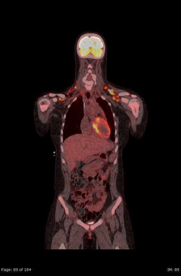 Brown fat uptake (FDG PET-CT) (Radiopaedia 77392-89513 Fused coronal 47).jpg