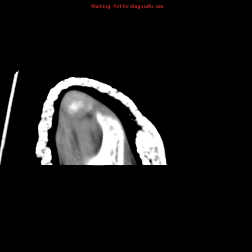 Brown tumor (Radiopaedia 12460-12694 Axial non-contrast 144).jpg