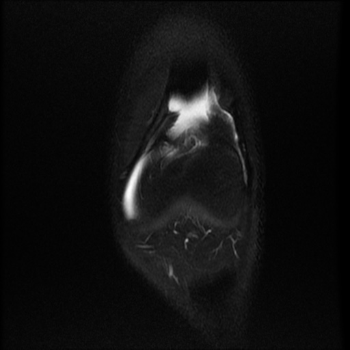 File:Bucket-handle meniscus tear (Radiopaedia 65700-74809 Coronal T2 fat sat 18).jpg