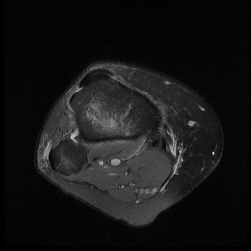File:Bucket handle meniscus tear (Radiopaedia 56916-63751 Axial PD fat sat 19).jpg