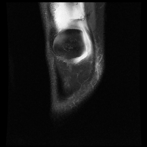 File:Bucket handle meniscus tear (Radiopaedia 56916-63751 Coronal PD fat sat 3).jpg