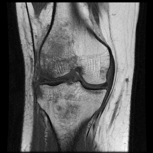 File:Bucket handle meniscus tear (Radiopaedia 56916-63751 Coronal T1 11).jpg