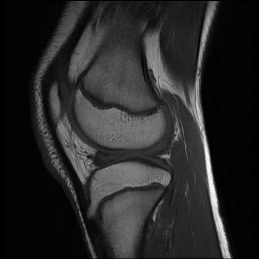 File:Bucket handle tear - lateral meniscus (Radiopaedia 72124-82634 Sagittal T1 5).jpg