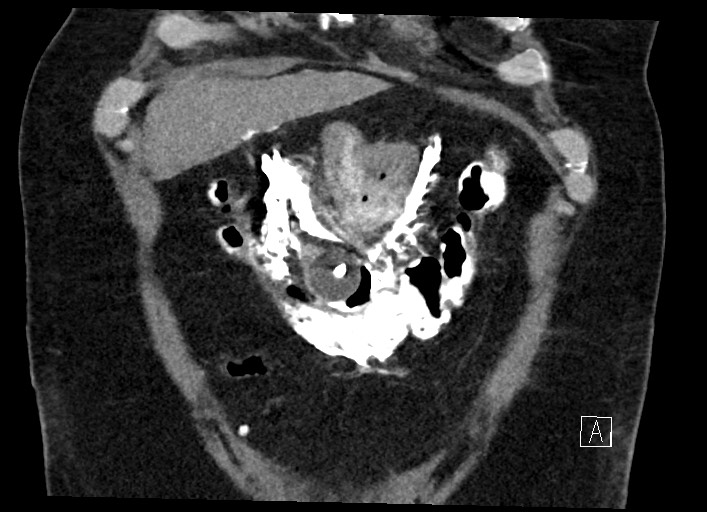 Buried bumper syndrome - gastrostomy tube (Radiopaedia 63843-72577 Coronal Inject 29).jpg
