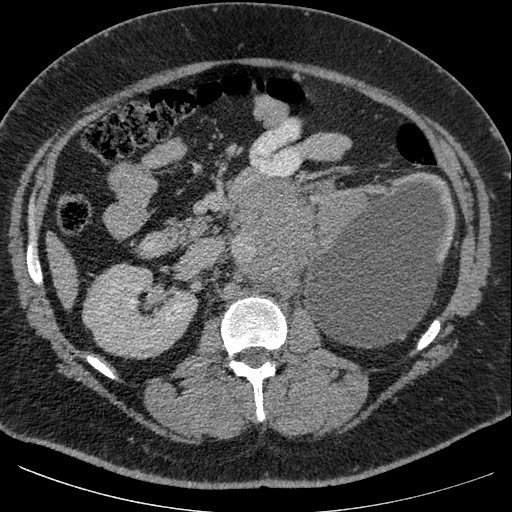 Burned-out testicular seminoma - retroperitoneal nodal metastases (Radiopaedia 62872-71245 A 31).jpg