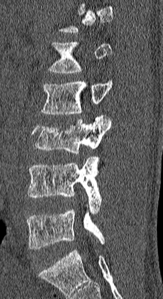 Burst fracture (Radiopaedia 53373-59357 Sagittal bone window 54).jpg