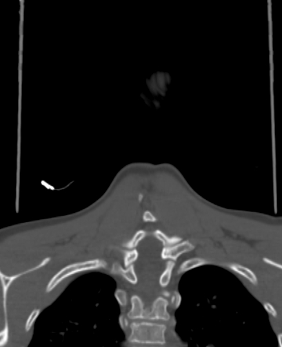 Butterfly vertebra (Radiopaedia 77903-90209 Coronal bone window 80).jpg