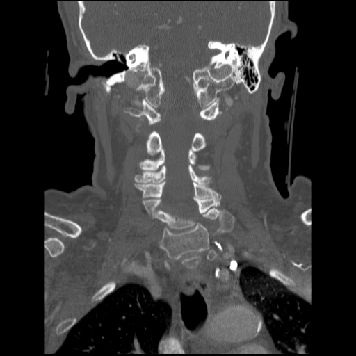 File:C1 anterior arch (plough) fracture - type 1 (Radiopaedia 76181-87720 Coronal bone window 47).jpg