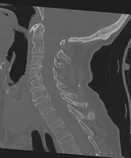 C2 fracture with vertebral artery dissection (Radiopaedia 37378-39199 Sagittal bone window 41).png