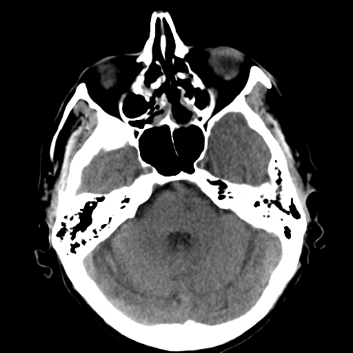 File:CNS lymphoma (Radiopaedia 36983-38639 Axial non-contrast 13).png