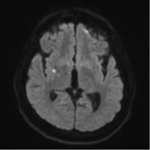 File:CNS vasculitis (Radiopaedia 55715-62263 Axial DWI 43).png