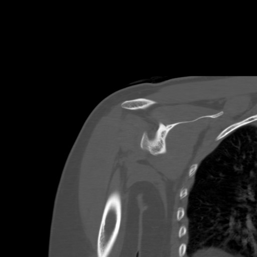 File:Calcific tendinitis of the infraspinatus tendon (Radiopaedia 87256-103539 Coronal bone window 33).jpg