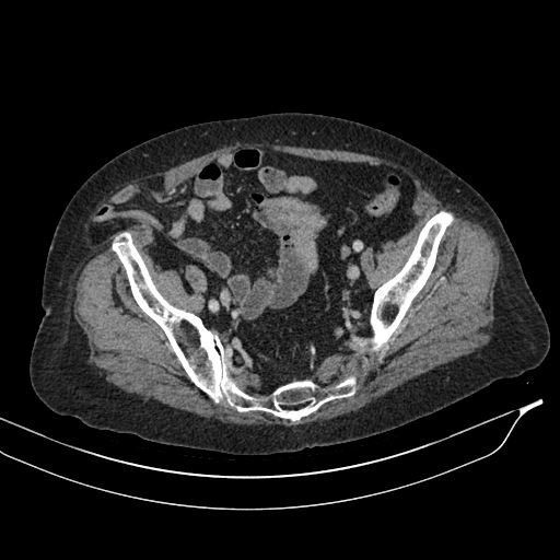 Calcified adrenal glands and Spigelian hernia (Radiopaedia 49741-54988 A 191).jpg