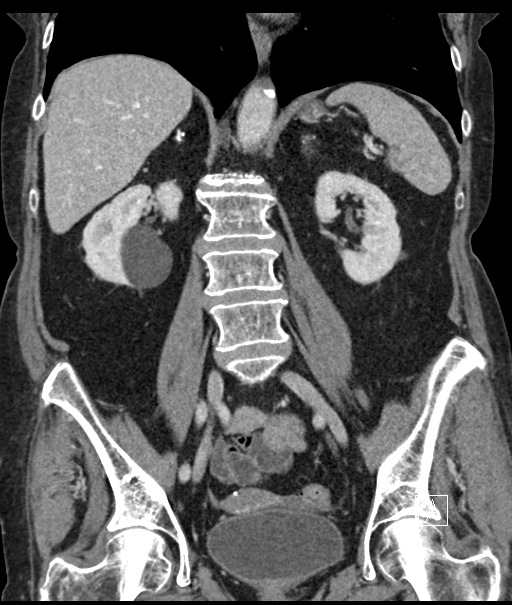 Calcified adrenal glands and Spigelian hernia (Radiopaedia 49741-54988 B 68).jpg